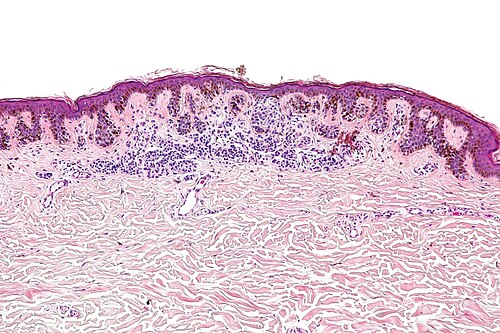 Dysplastic nevus - intermed mag.jpg