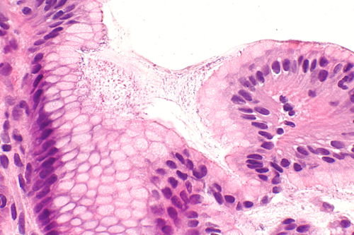 Helicobacter gastritis -- very high mag.jpg