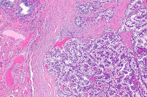 Papillary cystadenoma of epididymis -- low mag.jpg