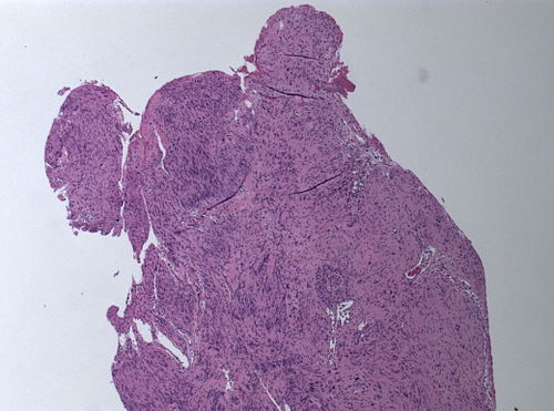 Neuropathology case I-Gomorri 03.jpg