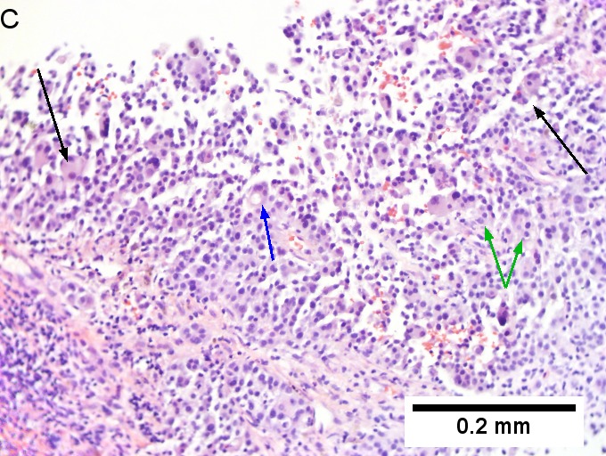 Melanoma metastatic to liver.