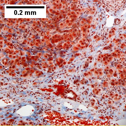 Bridging fibrosis, trichrome