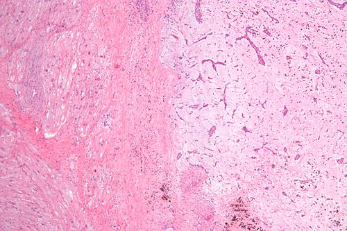 Atrial myxoma edge low mag.jpg
