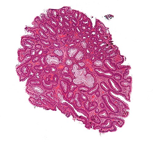 Tubular adenoma 4 low mag.jpg