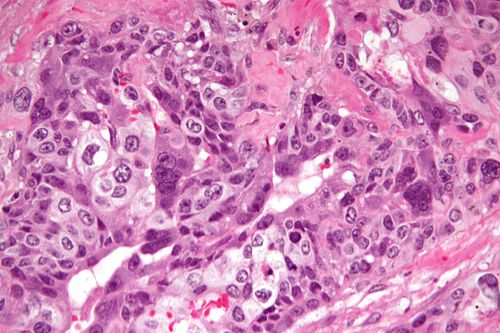 Choriocarcinoma -2- very high mag.jpg