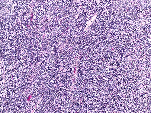 Highly cellular leiomyoma at 200x.jpg