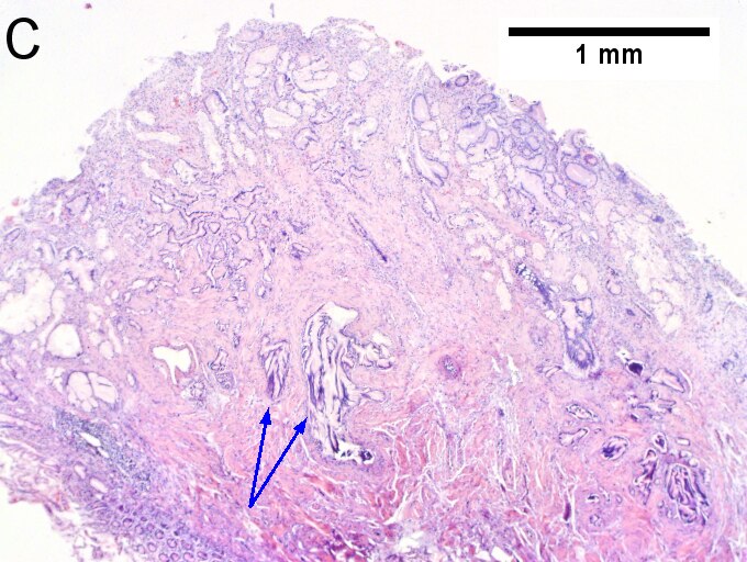 Invasive carcinoma of duodenal ampulla.