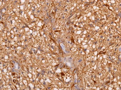 Neuropathology case V 04.jpg