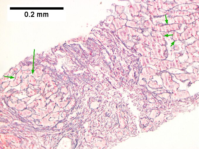 Cirrhosis in an alcoholic.