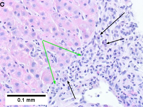 Drug induced liver injury in a young adult man