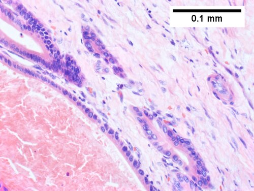 Intraductal papillary neoplasm of common bile duct with associated invasive carcinoma.