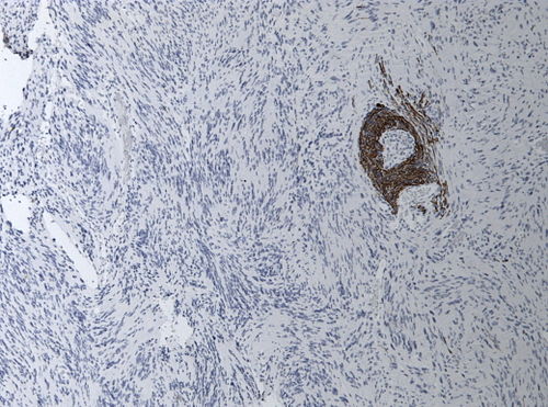 Neuropathology case I-Gomorri 05.jpg