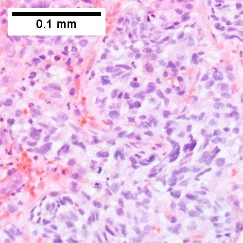 Metastatic poorly differentiated neuroendocrine carcinoma of pulmonary origin.