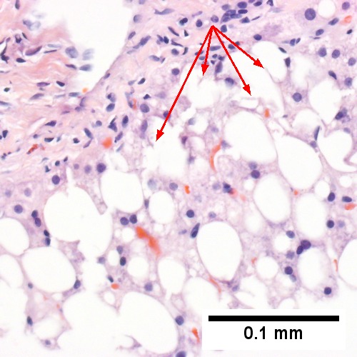 Cytoplasmic tufts (arrows) prove ballooning degeneration (Row 2 Left 400X).