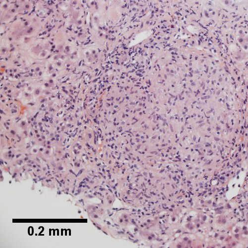 Well-formed granuloma