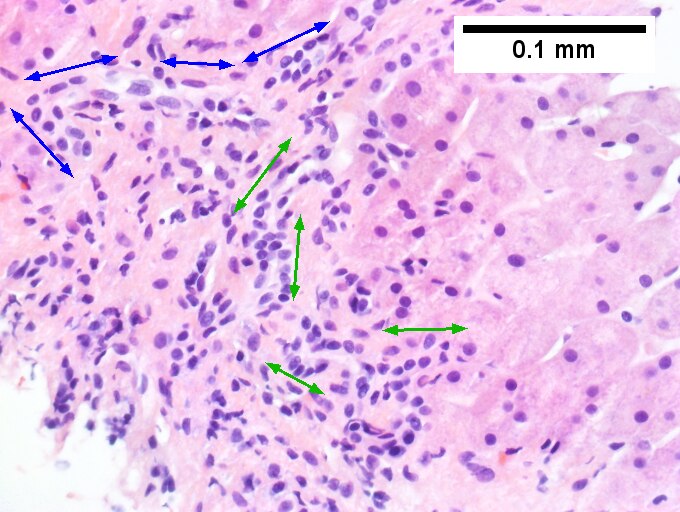 Cirrhosis in an alcoholic.