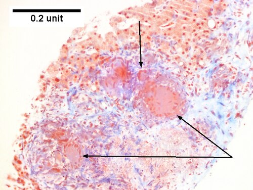 Hepatic sarcoidosis in a patient with previously known sarcoidosis.