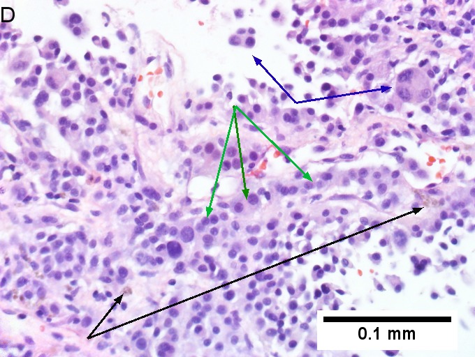 Melanoma metastatic to liver.