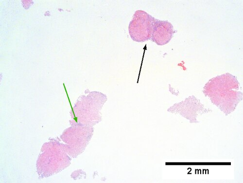 Hepatitis C virus. Metavir activity index 3 (PMN 2, LN 2). Metavir stage 4 (cirrhosis, definite by old criteria).