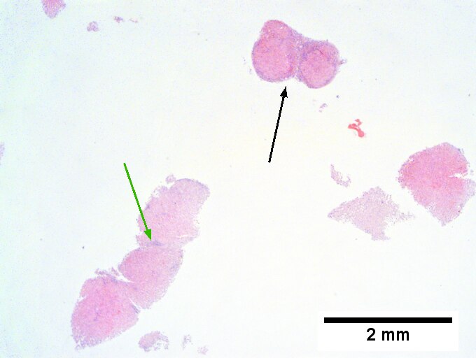 Hepatitis C virus. Metavir activity index 3 (PMN 2, LN 2). Metavir stage 4 (cirrhosis, definite by old criteria).