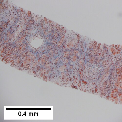 Trichrome shows periportal & sinusoidal fibrosis. No bridging was seen. (100X).