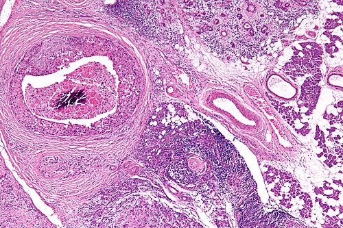 Salivary duct carcinoma - low mag.jpg