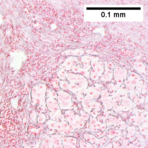 Reticulin stain shows two cell thick regenerative cords with sinusoidal black lines lacking orientation (Row 2 Right 400X).