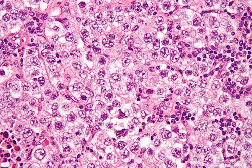 Seminoma high mag.jpg