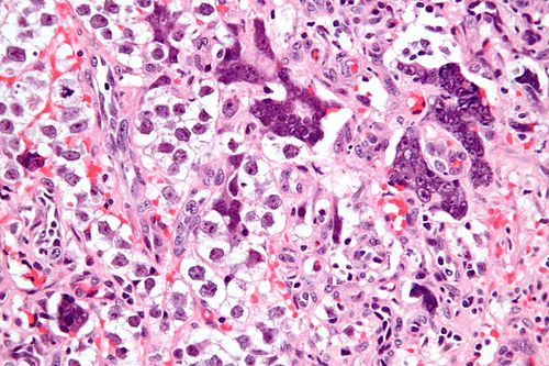 Seminoma with syncytiotrophoblasts - very high mag.jpg