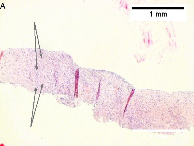 Cholangiocarcinoma with associated abscess