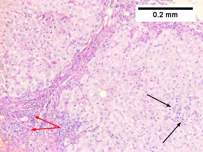 Hepatitis C virus. Metavir activity index 3 (PMN 2, LN 2). Metavir stage 4 (cirrhosis, definite by old criteria).