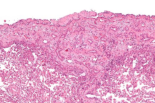 Malignant epithelioid mesothelioma - intermed mag.jpg