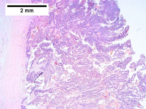 Intraductal papillary neoplasm of common bile duct with associated invasive carcinoma.