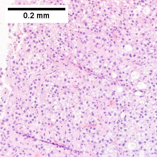 Hepatocellular carcinoma with fragments of liver afflicted by steatosis & with regenerative, benign fragments.