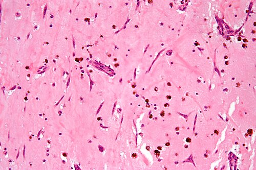 Atrial myxoma intermed mag.jpg