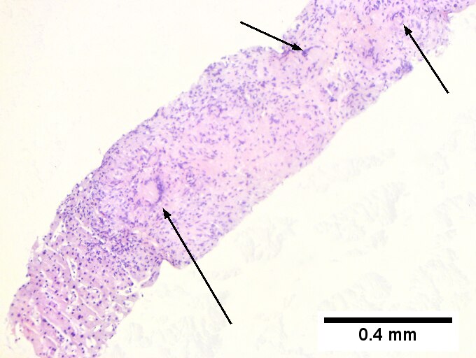 Hepatic sarcoidosis in a patient with previously known sarcoidosis.