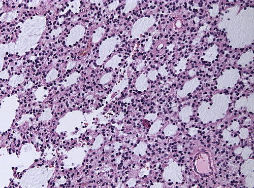 Neuropathology case II 02.jpg