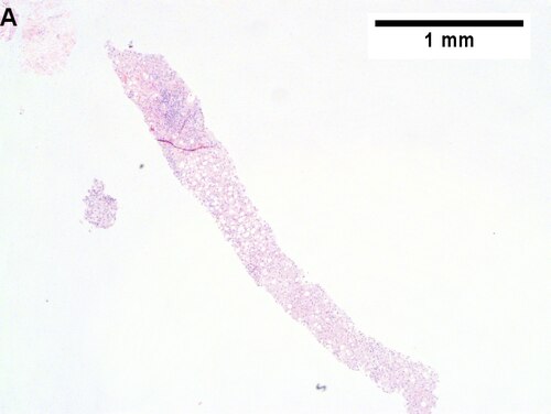Changes of steatohepatitis and interface hepatitis, with granuloma. Patient with diabetes was ANA, AMA, HCV, HBV negative, without drugs known to produce granulomas or interface hepatitis. This may be a case of AMA negative primary biliary cirrhosis, but studies to determine that with certainty were not performed.