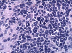 HE anaplastic epedymomas mitoses pleomorphism.jpg