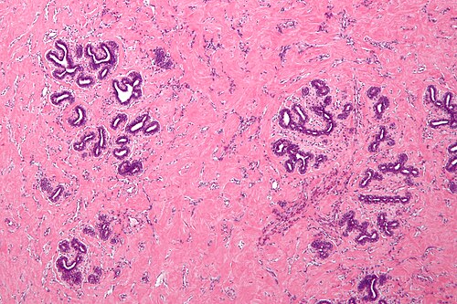 Pseudoangiomatous stromal hyperplasia -a- low mag.jpg