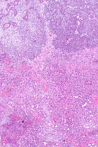 Carcinoma ex pleomorphic adenoma - a1 -- low mag.jpg