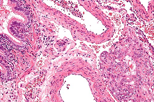 Lymphangioleiomyomatosis - high mag.jpg