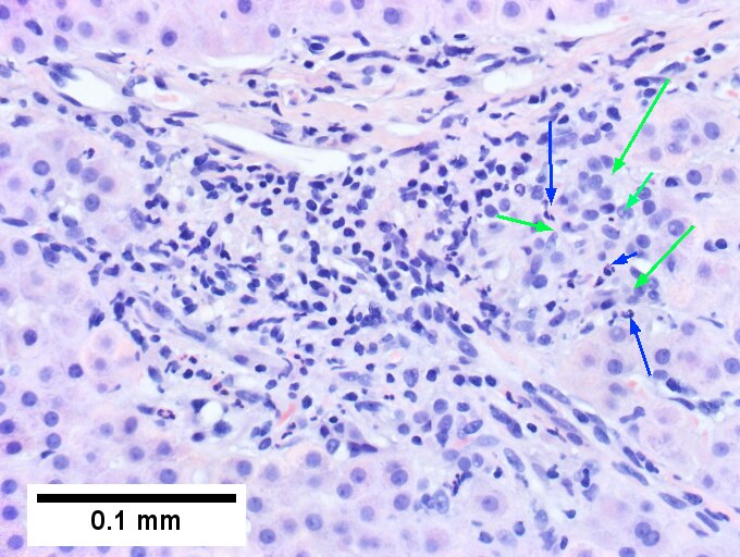 Primary sclerosing cholangitis in patient with history of ulcerative colitis.