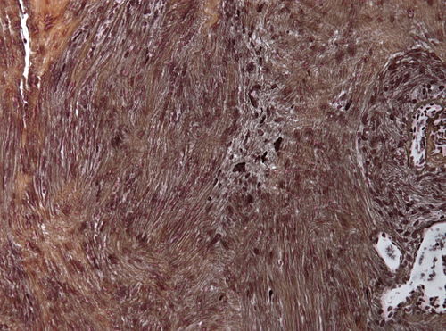 Neuropathology case I-Gomorri 01.jpg