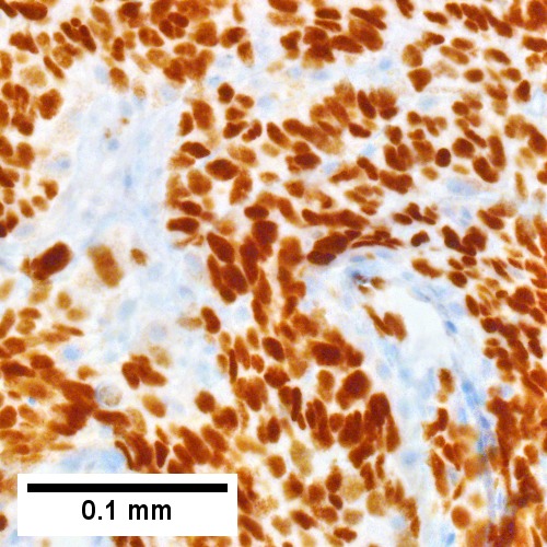 Metastatic poorly differentiated neuroendocrine carcinoma of pulmonary origin.